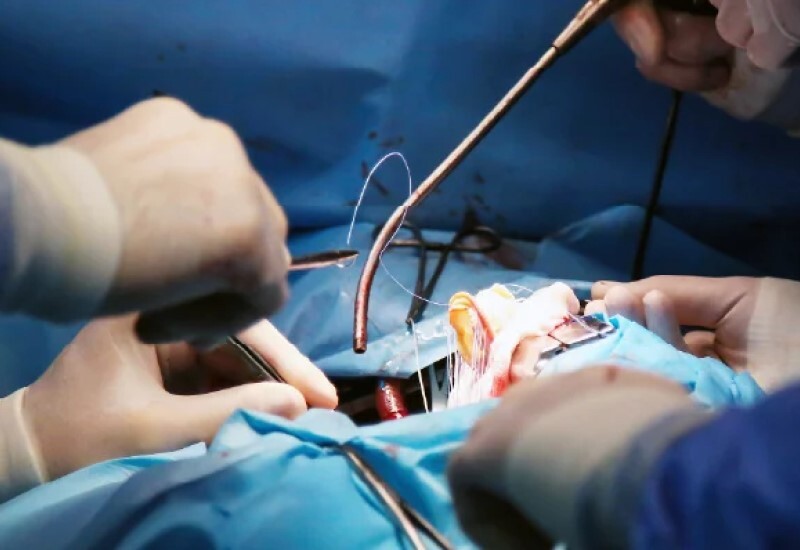 CABG Reimagined: Innovation, Precision, and Growth